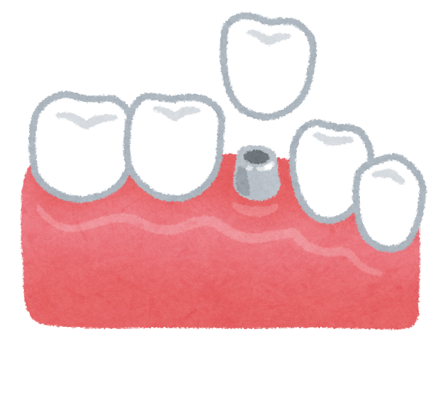 teeth_implant